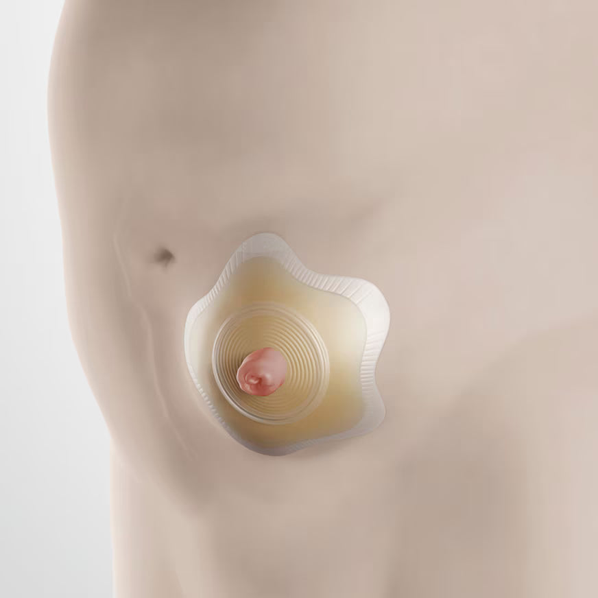 Coloplast SenSuraยฎ Mio Concave 2-Piece Click BasePlate - Okotoks HC Pharmacy