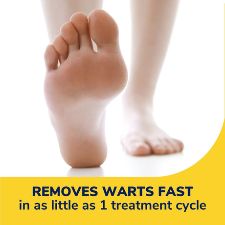 Close-up of a foot with text about warts removal on a yellow and white background - okotoks hc pharmacy