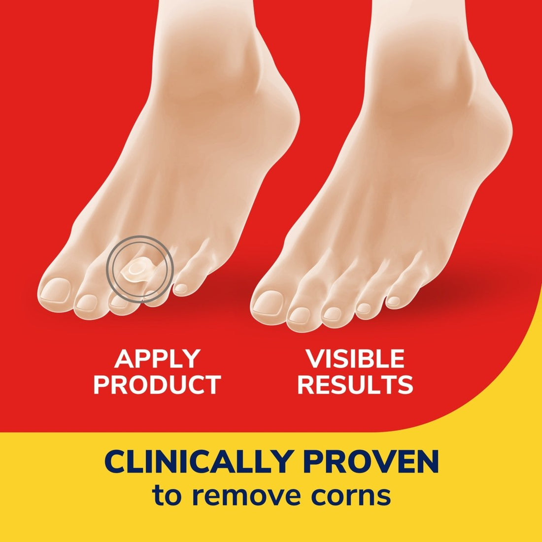 Advertisement for a corn removal product showing feet with corns and text about application and results. - okotoks hc pharmacy