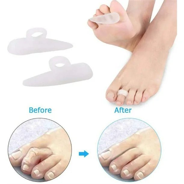 Silicone gel pads for toe separation with 'Before' and 'After' comparisons on a white background. - okotoks hc pharmacy