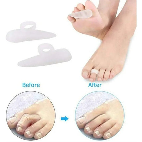 Silicone gel pads for toe separation with 'Before' and 'After' comparisons on a white background. - okotoks hc pharmacy